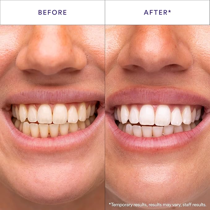 Original Hismile Teeth Whitening Strips